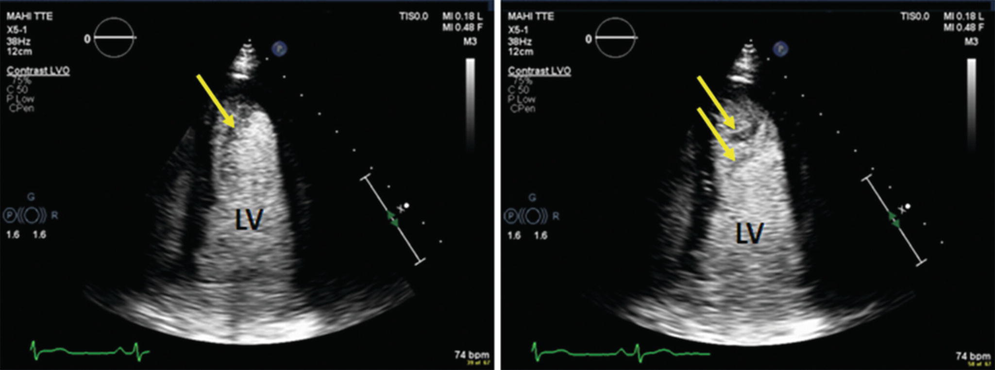 Contrast Echocardiography Springerlink