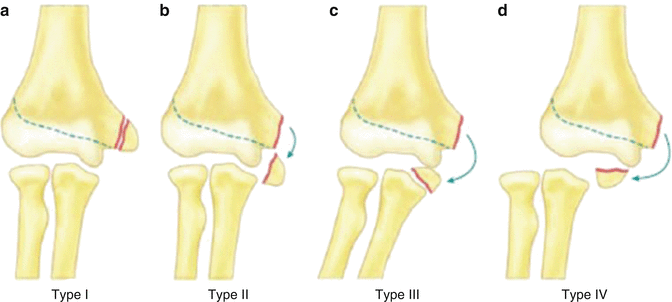 Medial Epicondyle Fractures Springerlink