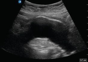 Abdominal Aortic Aneurysm Ultrasound Springerlink