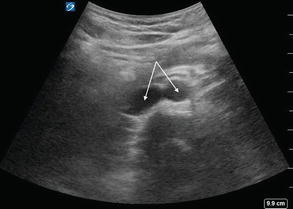 Abdominal Aortic Aneurysm Ultrasound Springerlink