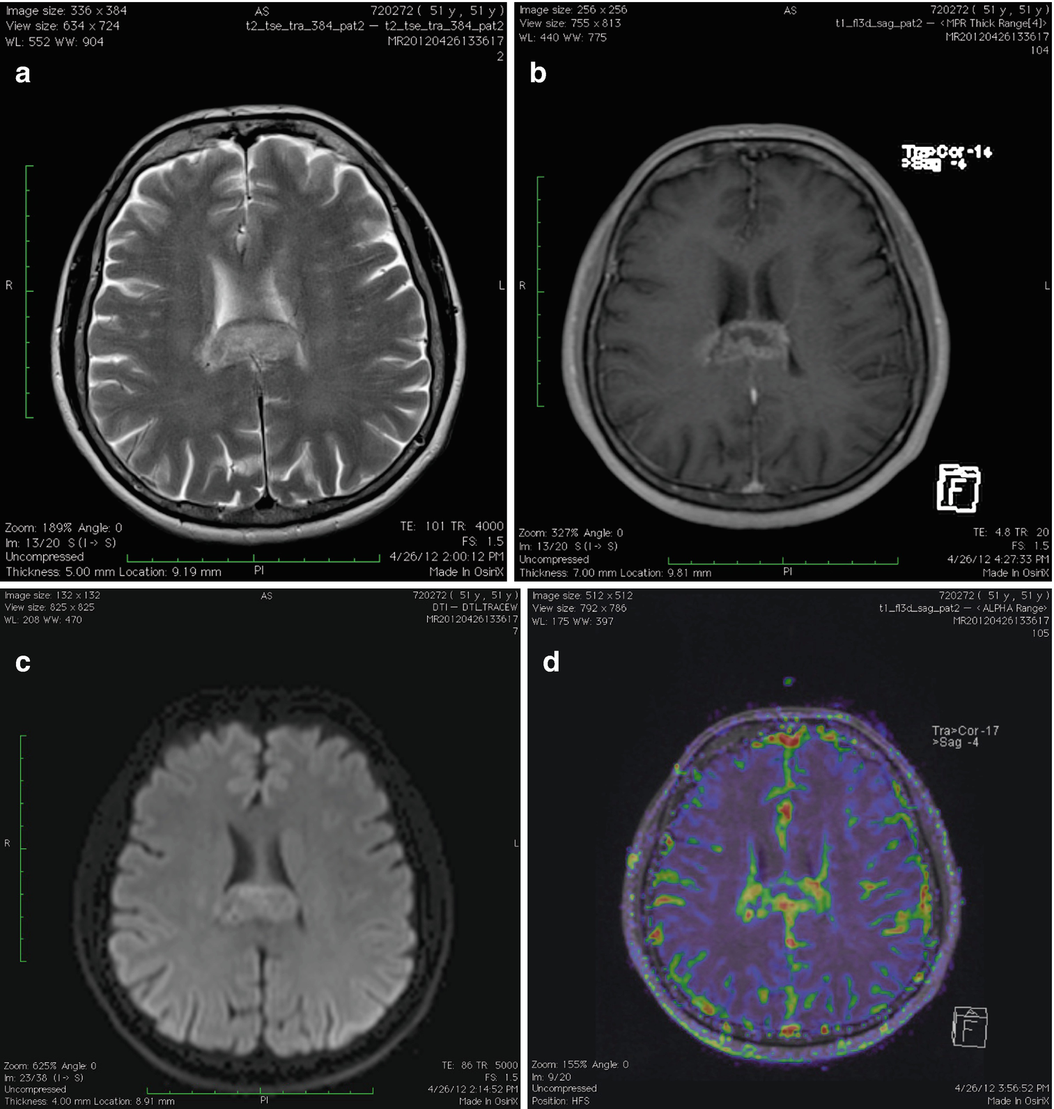 Advanced MRI Techniques in Brain Tumors | SpringerLink