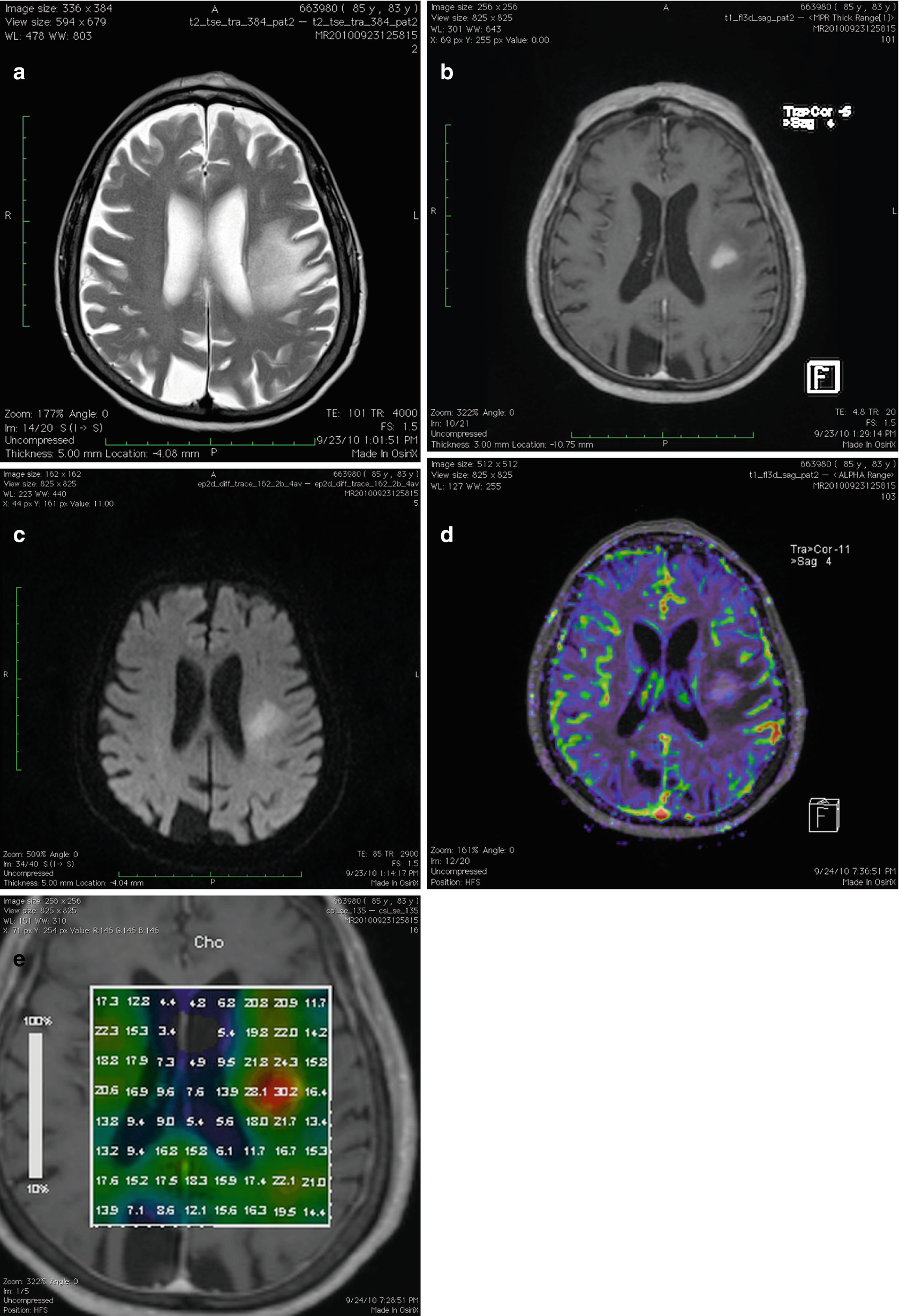 Advanced MRI Techniques in Brain Tumors | SpringerLink