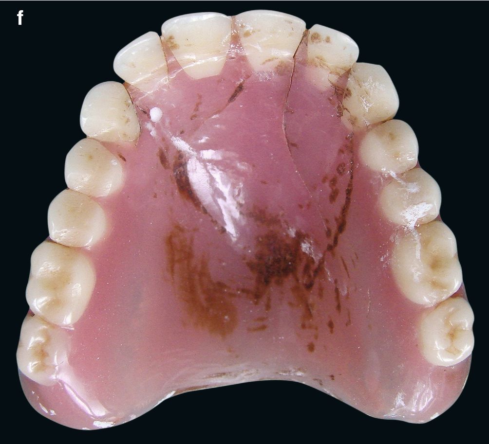 Long Term Problems With Complete Dentures Springerlink - 