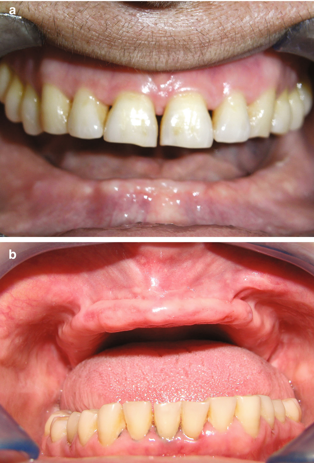 Single Complete Dentures Springerlink
