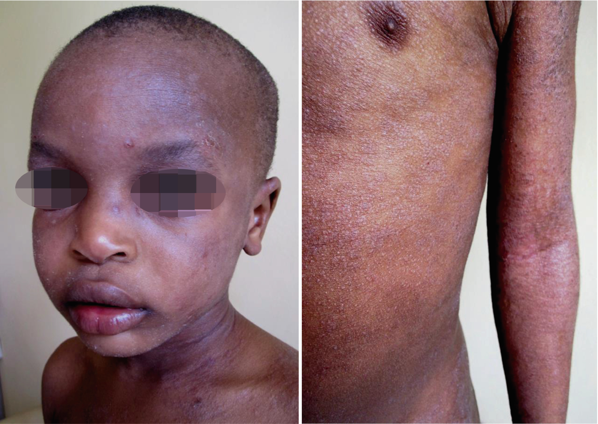 Atopic Dermatitis In Skin Of Color Springerlink