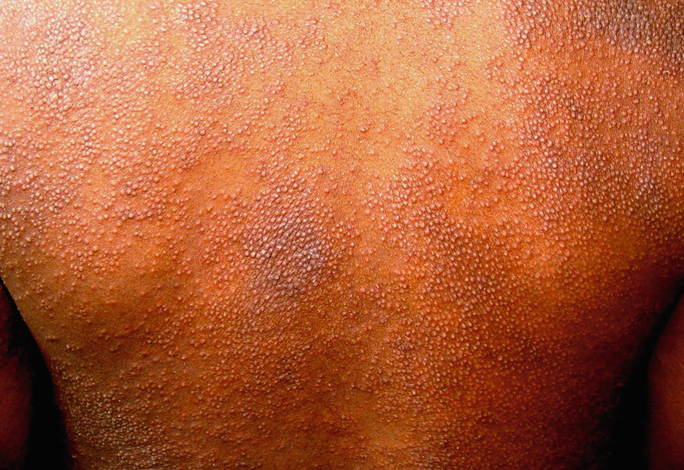 Nummular Eczema American Osteopathic College Of Dermatology Aocd