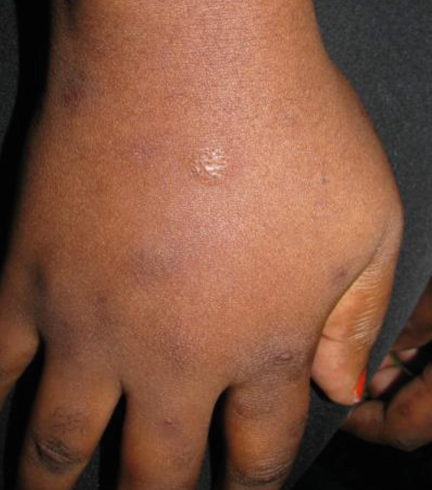 Cutaneous Manifestations of Torture and Intentional Abuse | SpringerLink Cutaneous Manifestations of Torture and Intentional Abuse | SpringerLink