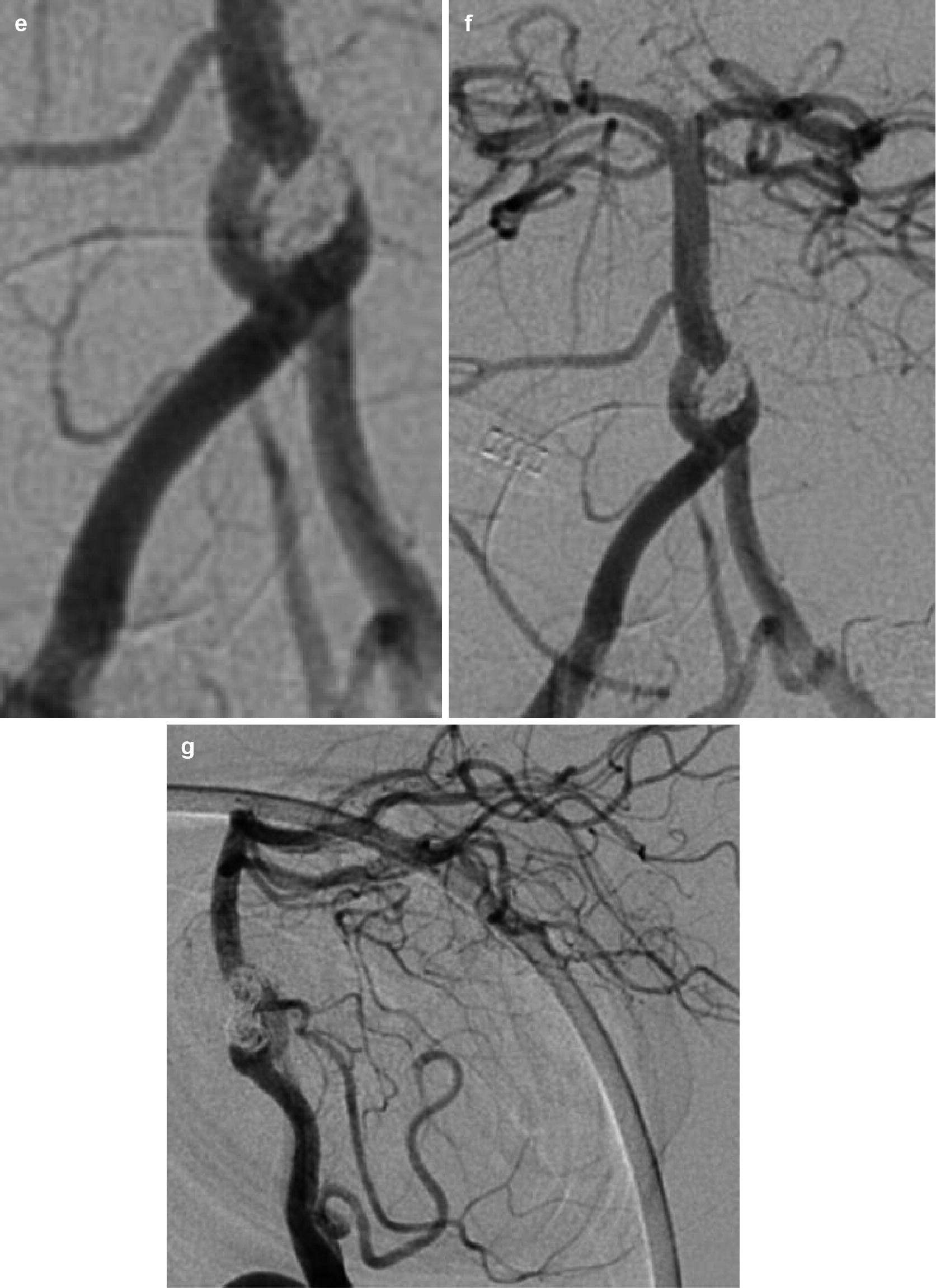 Basilar Artery Trunk Aneurysm A Complex Aneurysm at a Basilar Artery