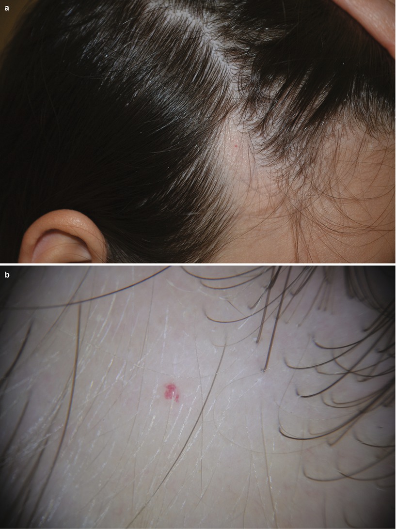 Congenital Triangular Alopecia Springerlink