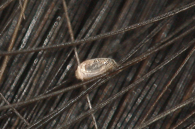 Pediculosis Springerlink
