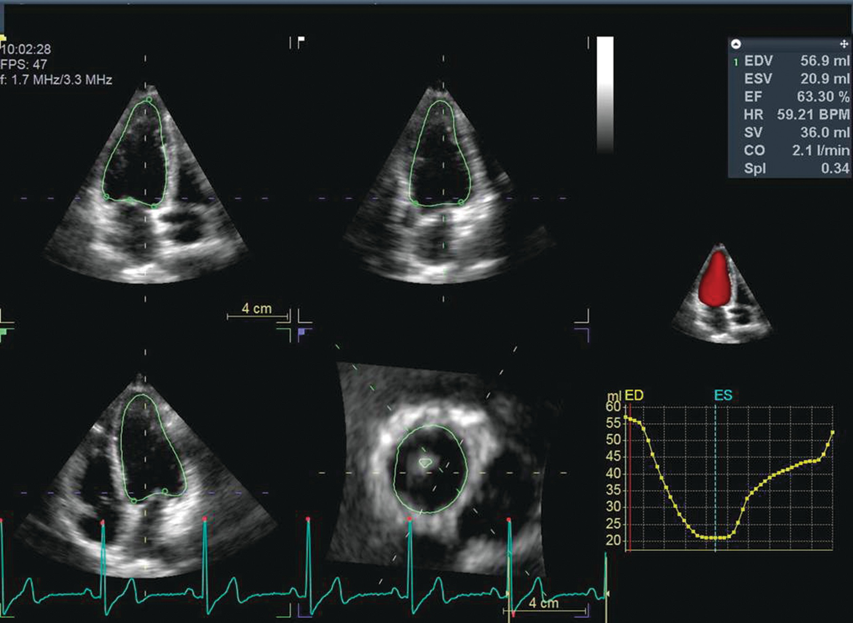 Principles Volume and Chamber ... of Measuring Size, Hemodynamic