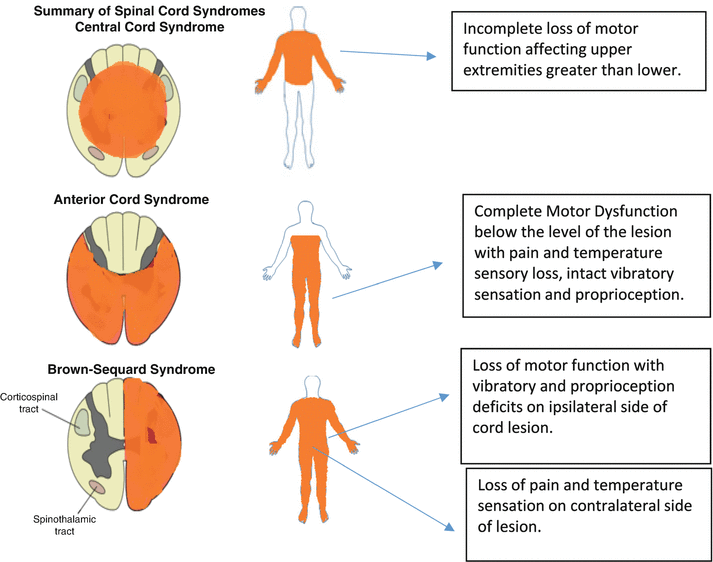 Spinal Cord Injury Springerlink