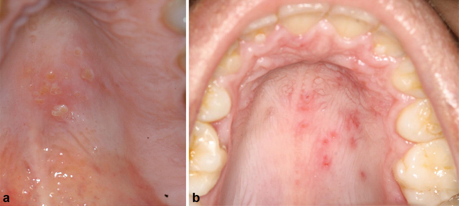 hpv herpes zoster vírus