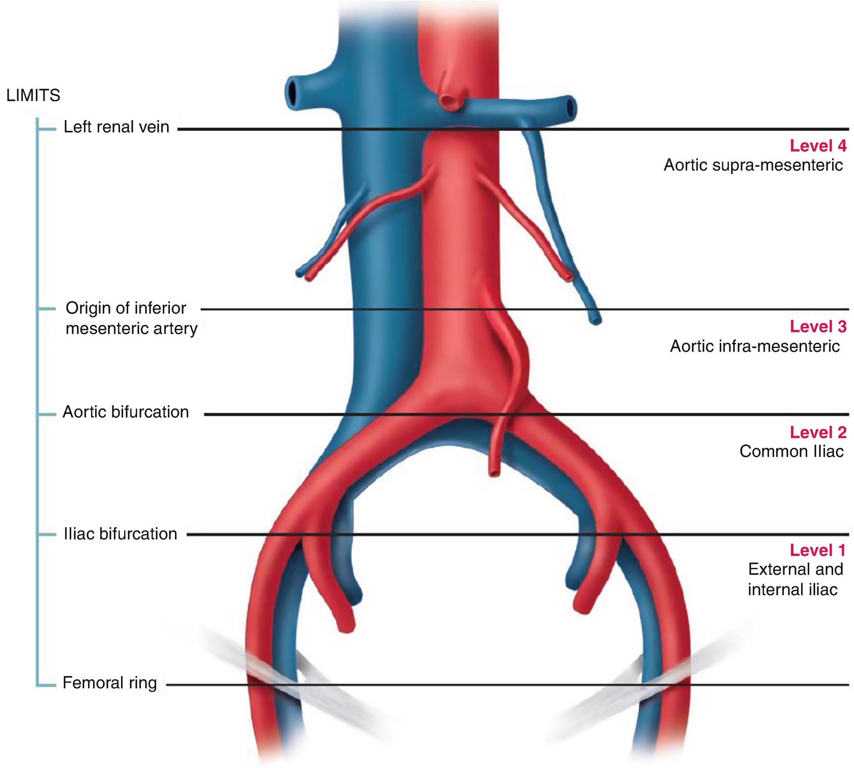 Classification of Radical Hysterectomy | SpringerLink