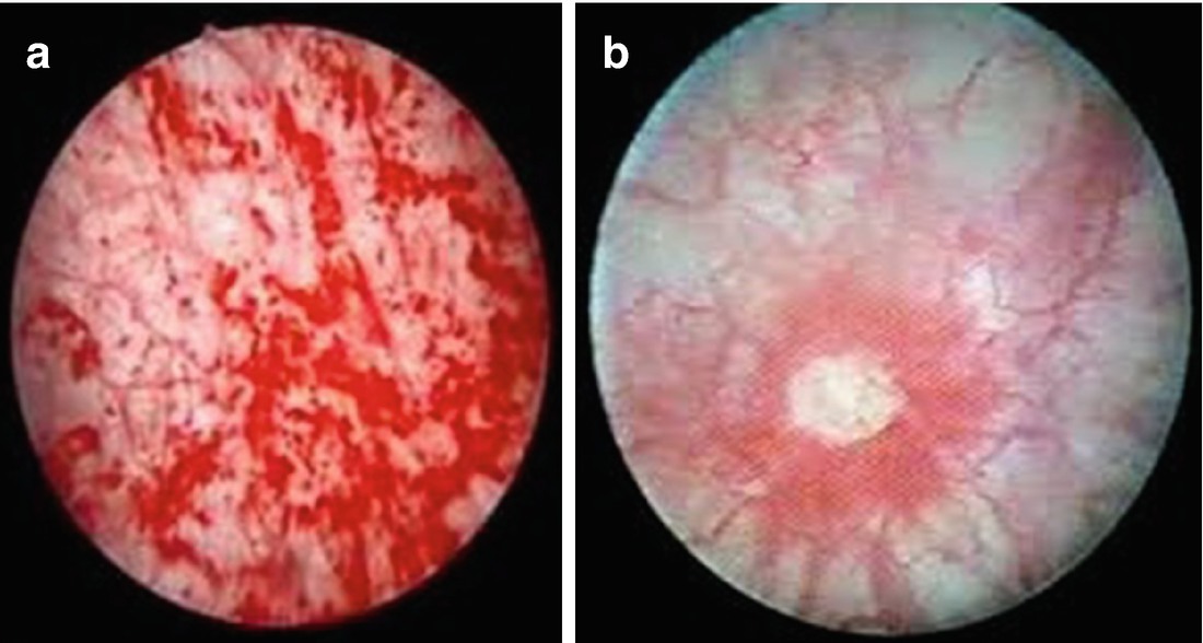 Uds In Pain Bladder Syndrome Pbs And Overactive Pelvic Floor