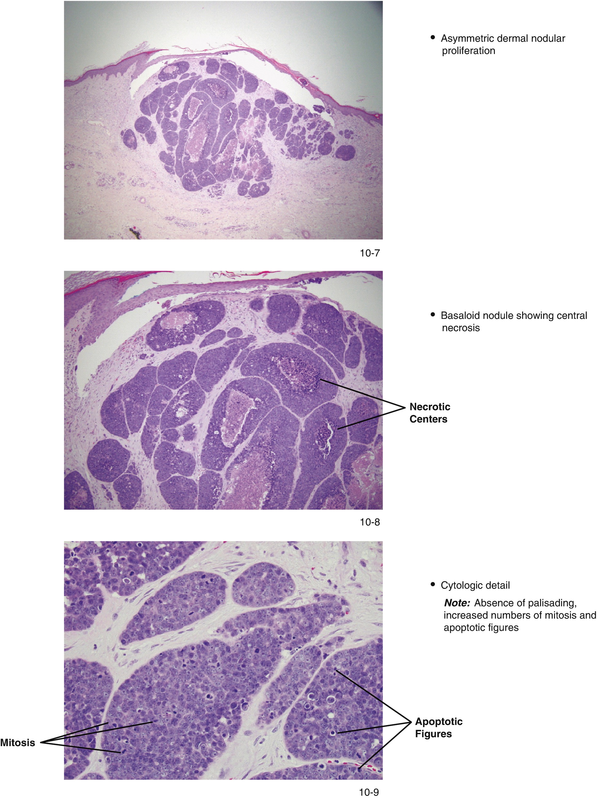 Merkel Cell Carcinoma Springerlink