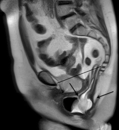 Mri Of The Pelvic Floor And Mr Defecography Springerlink