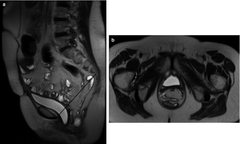 Mri Of The Pelvic Floor And Mr Defecography Springerlink