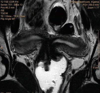 Benign Disease Of The Uterus Springerlink Benign Disease Of The Uterus Springerlink
