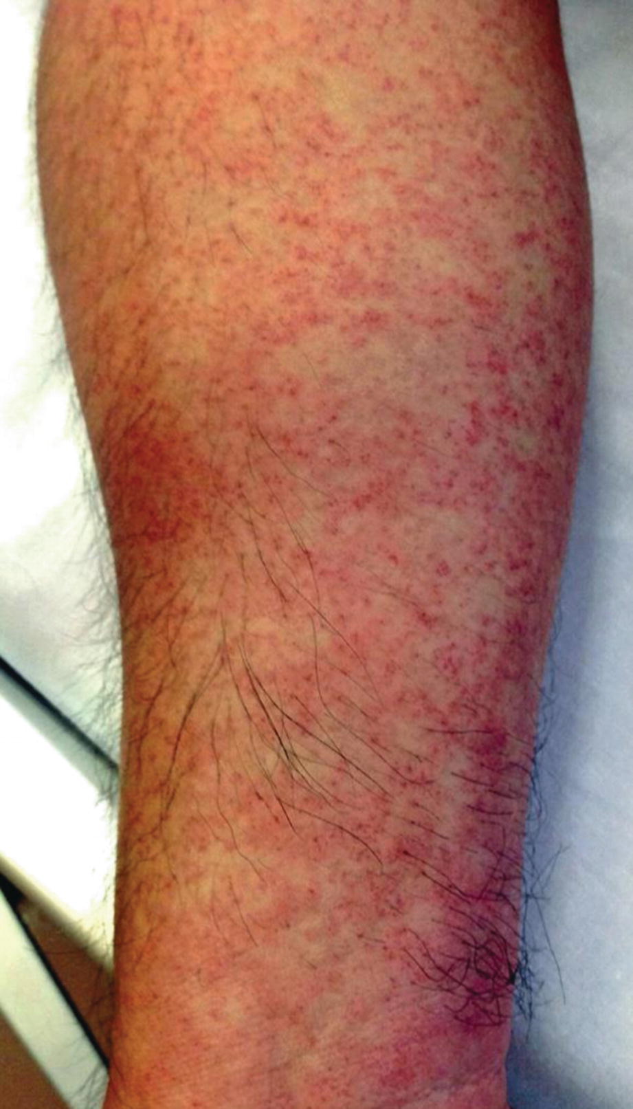 picture Salmonella Typhi Rash other potentially life threatening