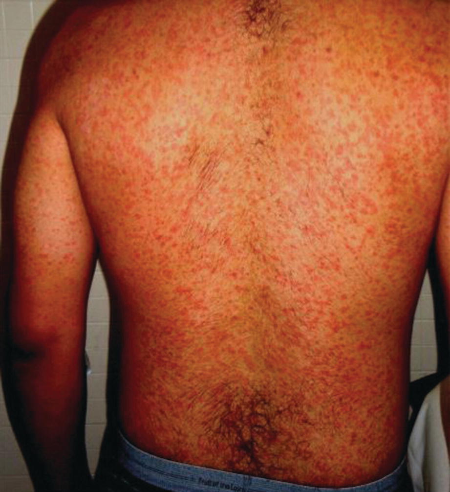 Other Potentially Life-Threatening Conditions with Mucocutaneous Findings  (Leptospirosis, Typhoid Fever, Dengue, Diphtheria, Murine Typhus) |  SpringerLink