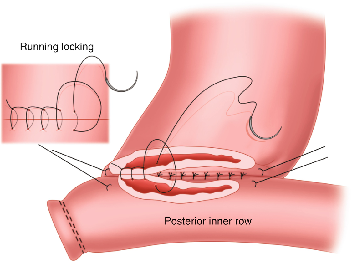 Fundamentals Of Gastrointestinal Anastomoses Springerlink