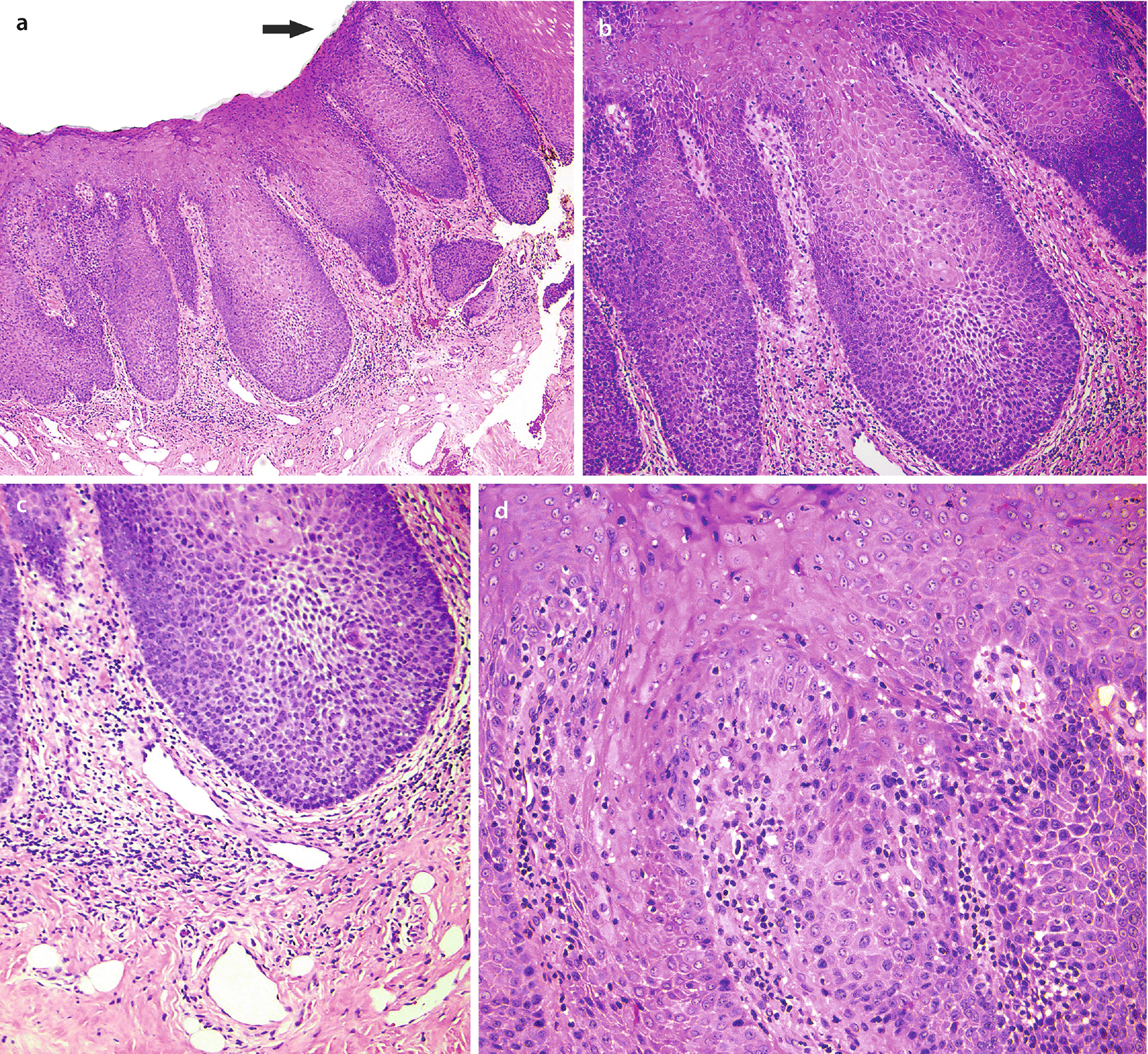 Oral Cavity Nonneoplastic And Benign Neoplasia Springerlink