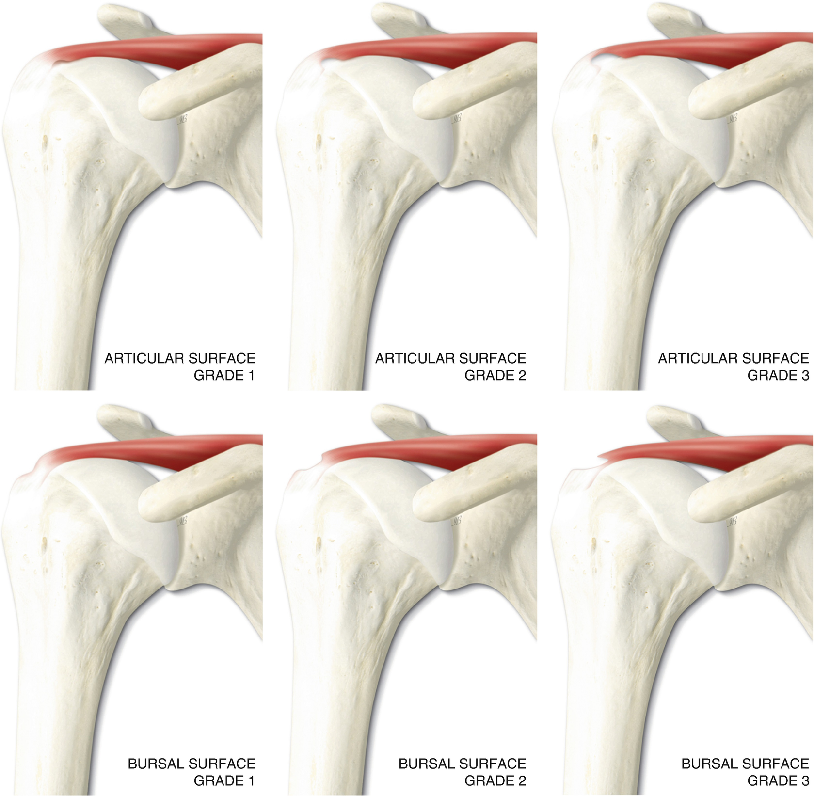 rotator cuff prognosis