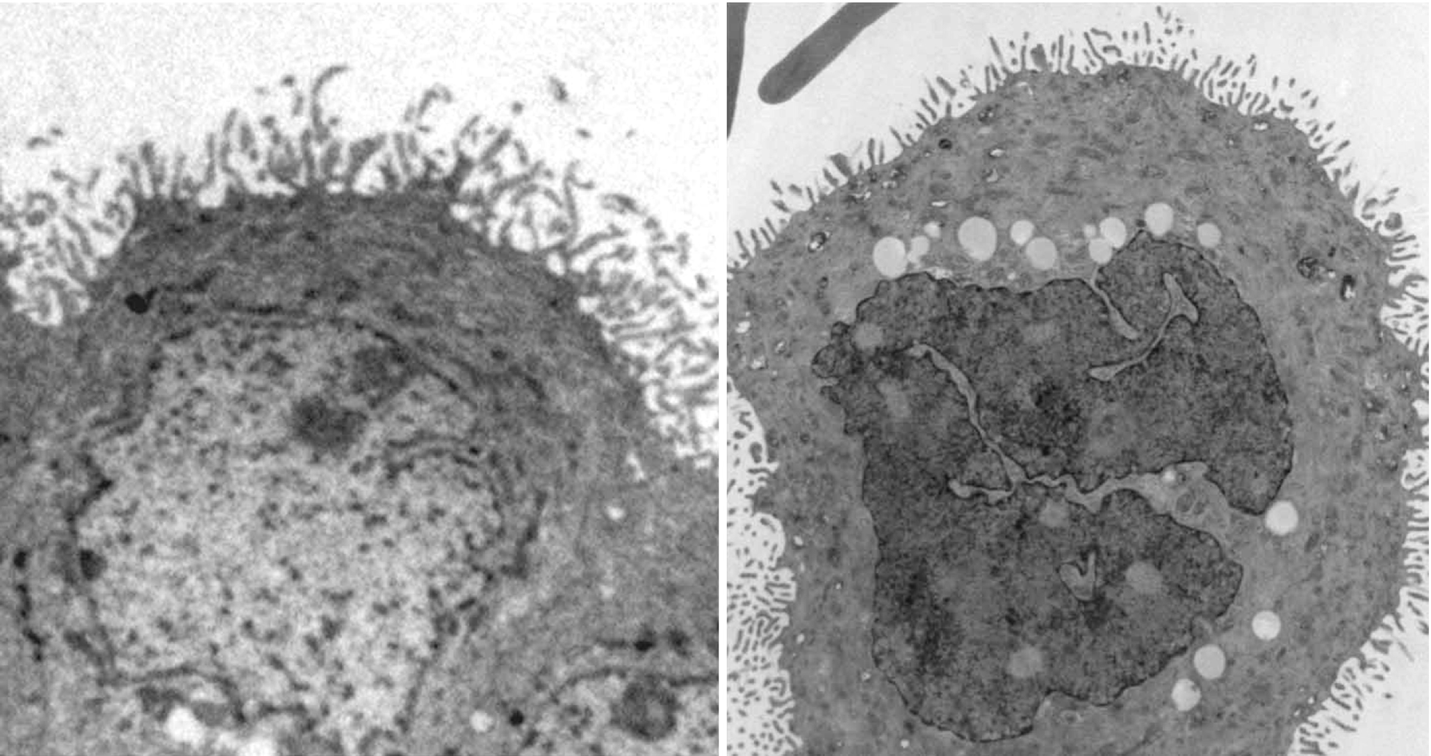 Malignant Mesothelioma Springerlink