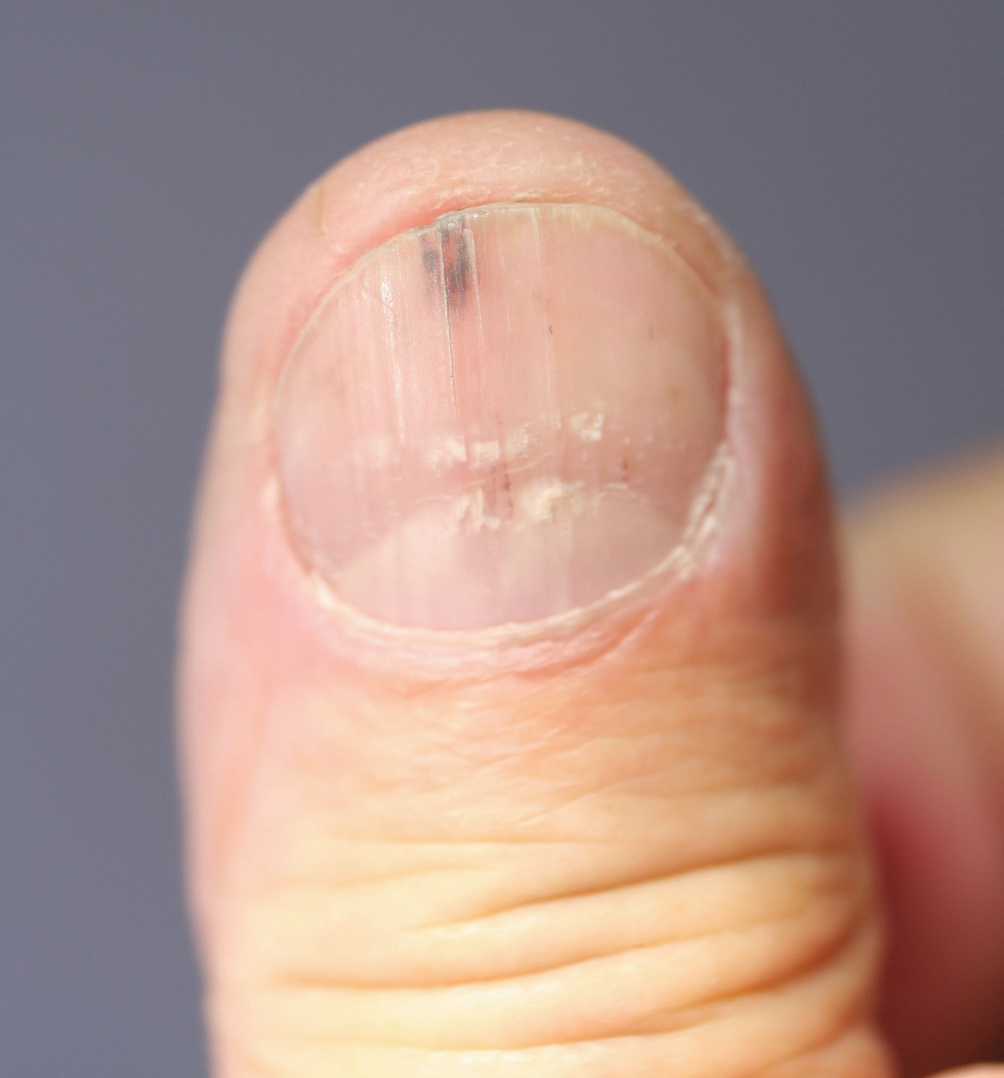 Lesion On The Nails Springerlink