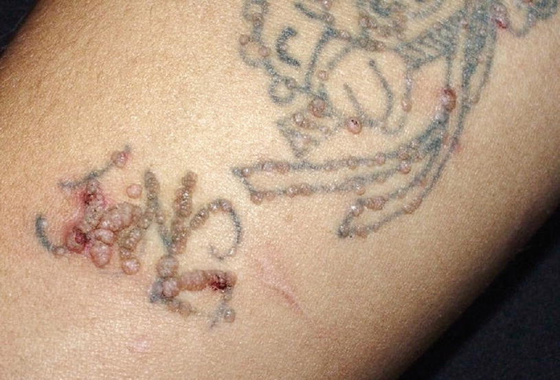Complications Of Tattooing And Scarring Springerlink
