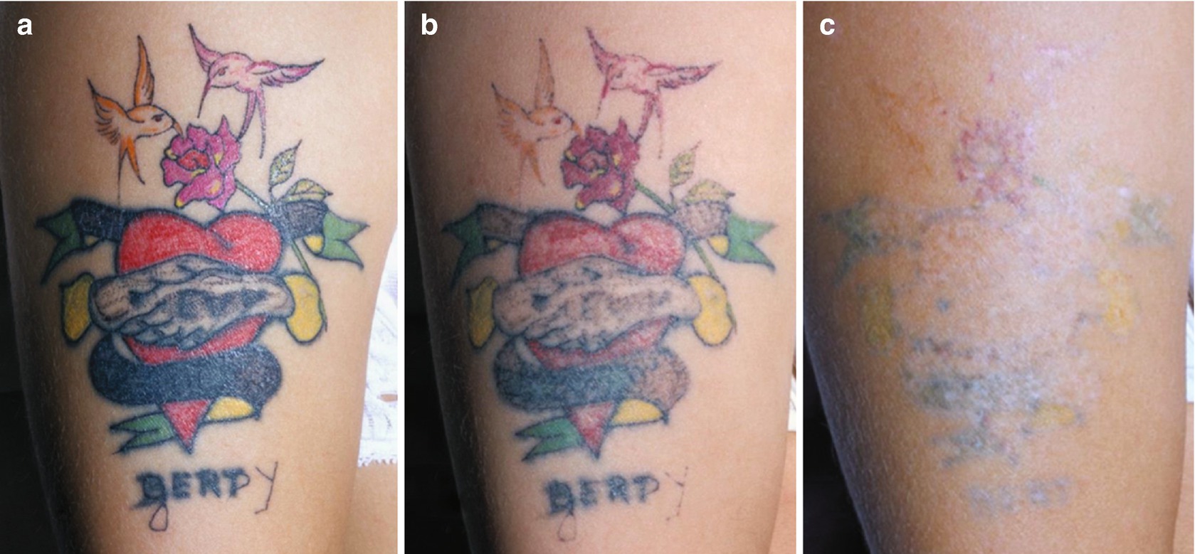 Tattoo Removal: Techniques and Devices | SpringerLink