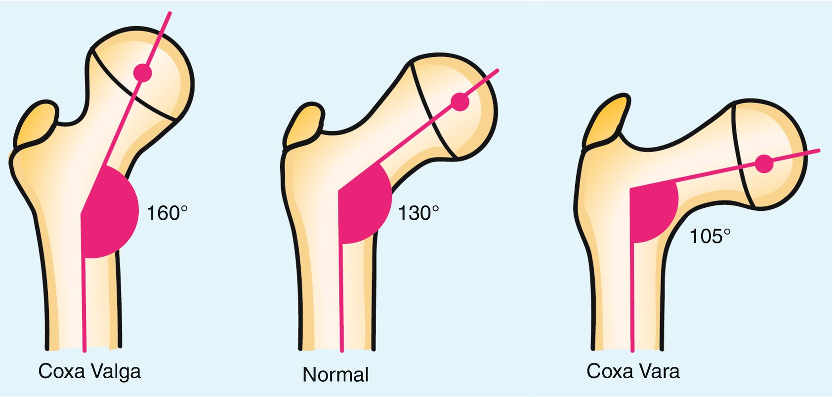 Coxa valga causes genu varum