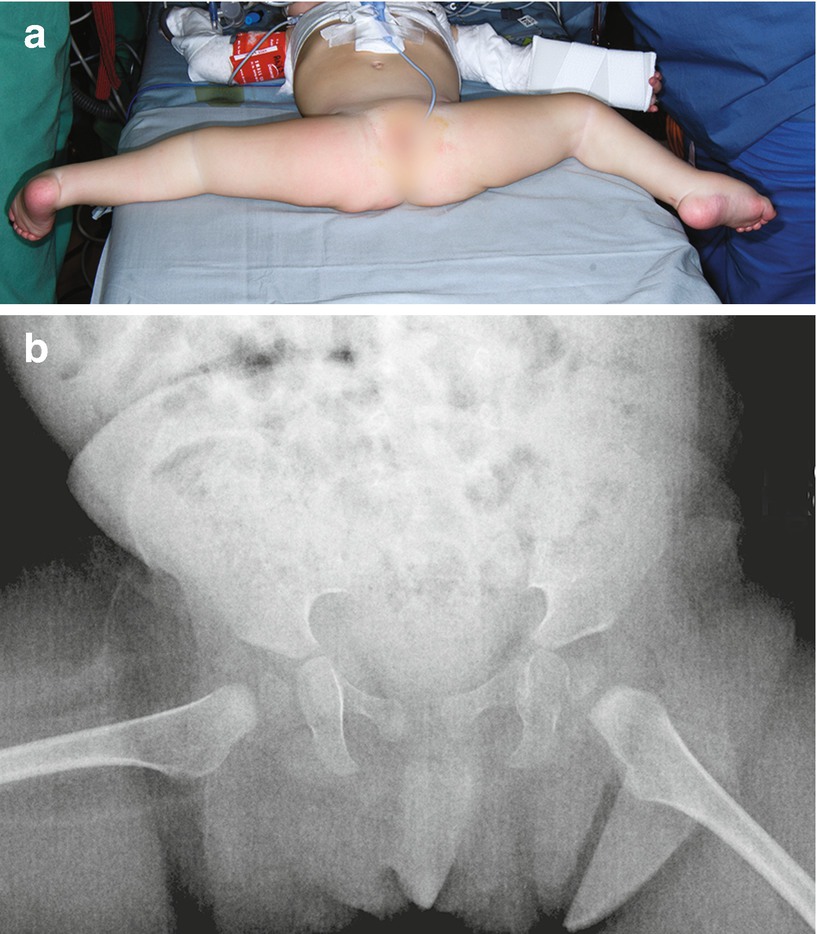 Body Cast Catheter Body Cast Catheter