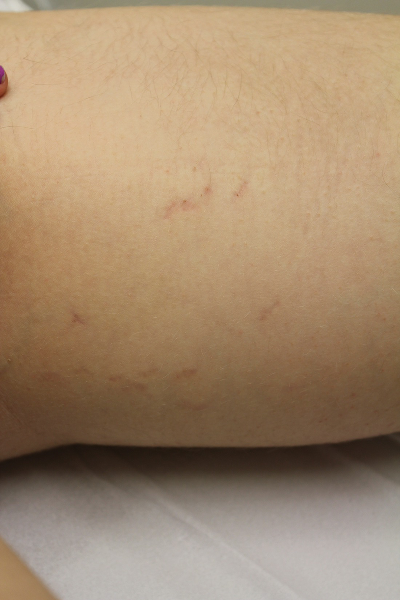 Petechiae on arms mild