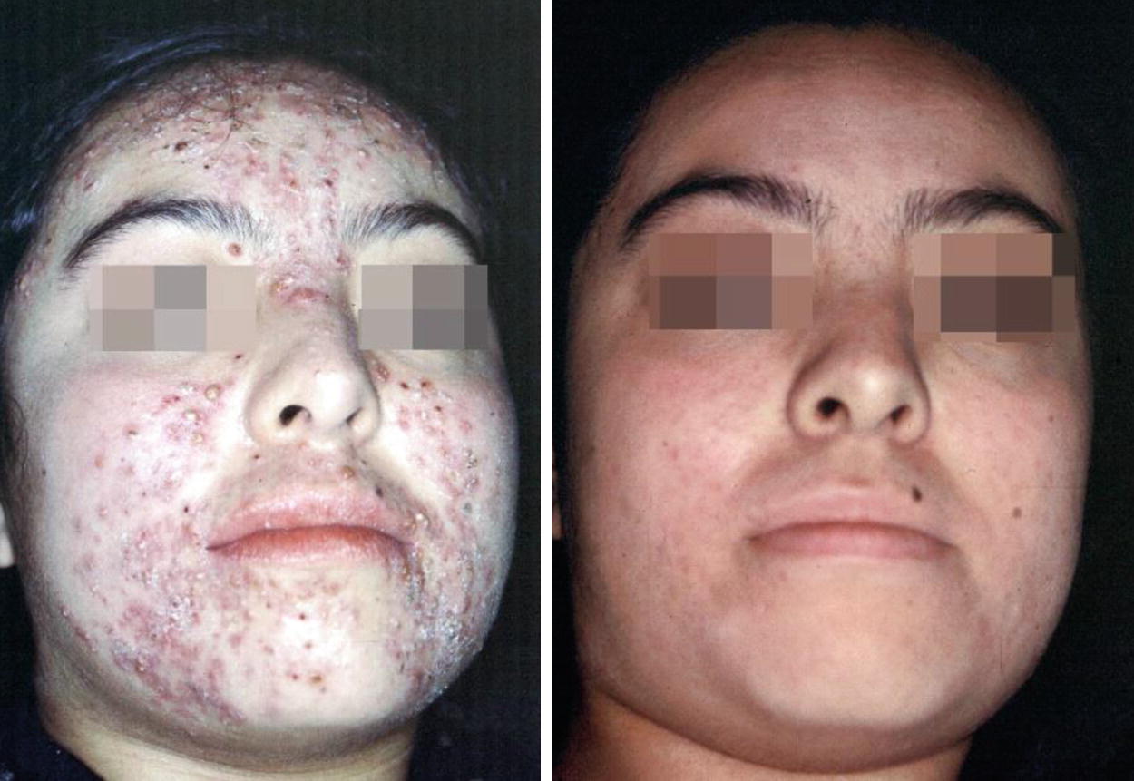 Salicylic Acid For Face Facial Salicylic Acid Peel Springerlink