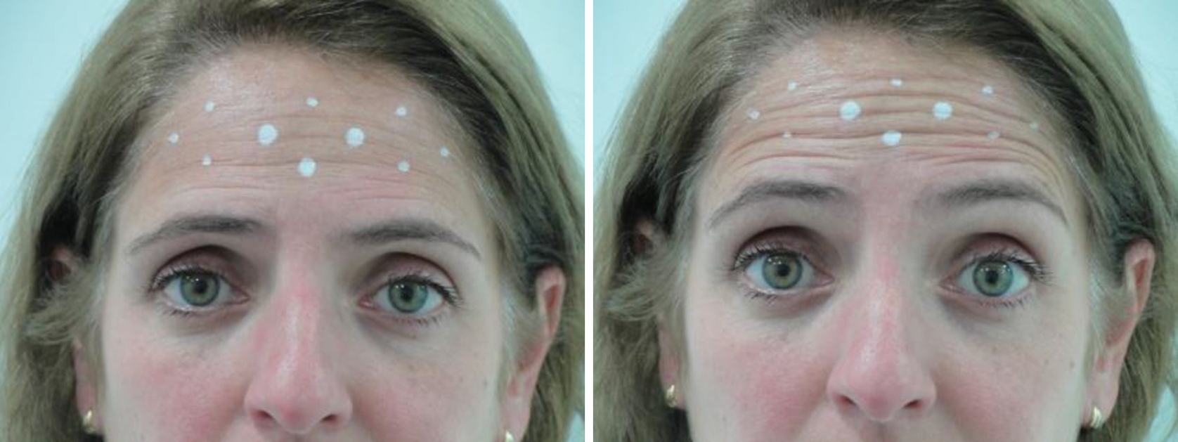 Botulinum Toxin For Superior Third Of The Face Springerlink