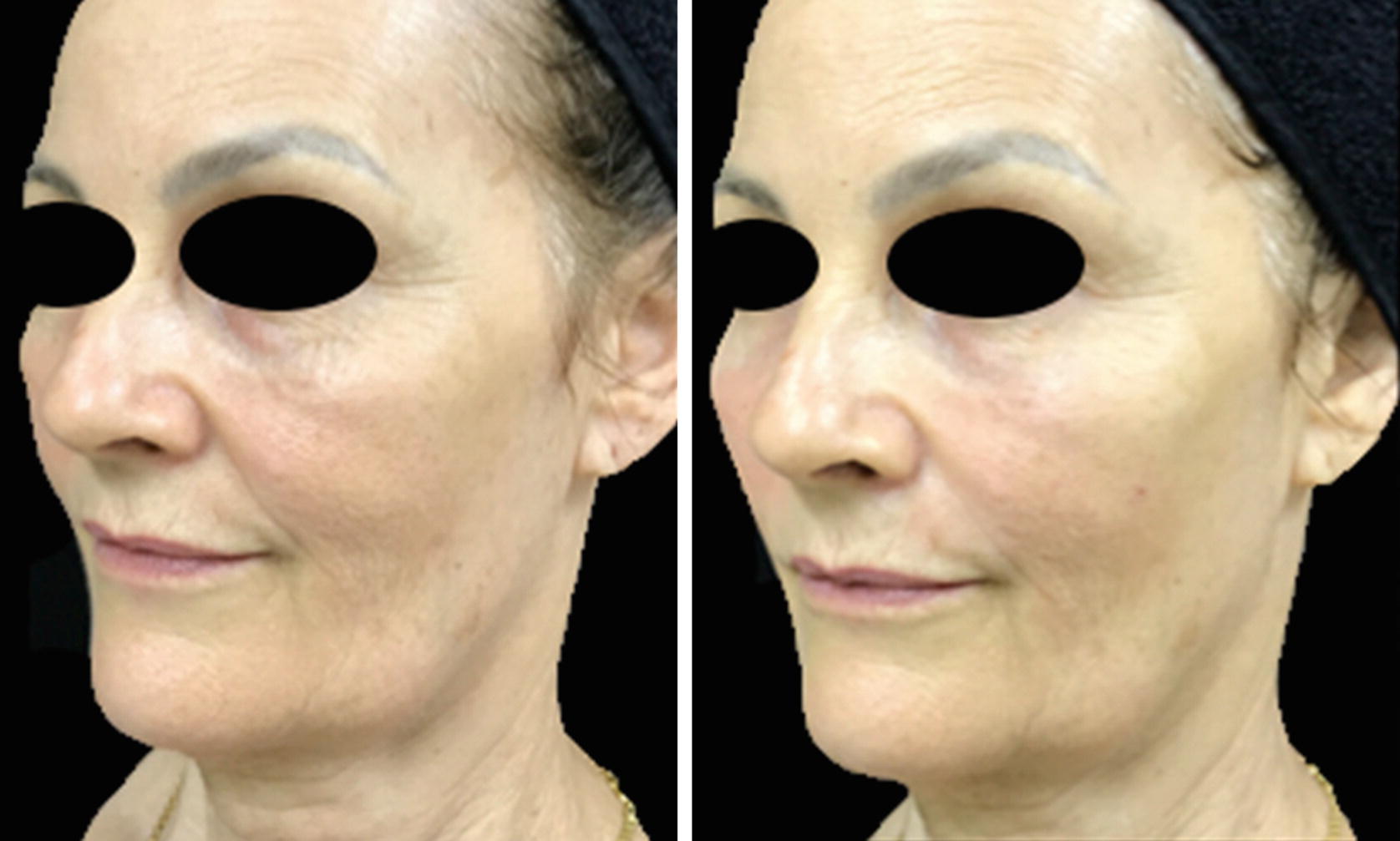 Hyaluronic Acid For Malar Area And Zygomatic Arch Springerlink