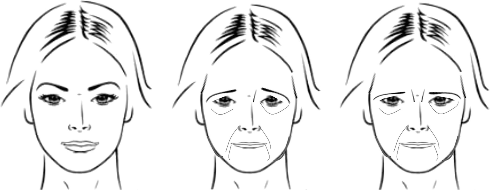 Eyebrow Thread Lifting Springerlink