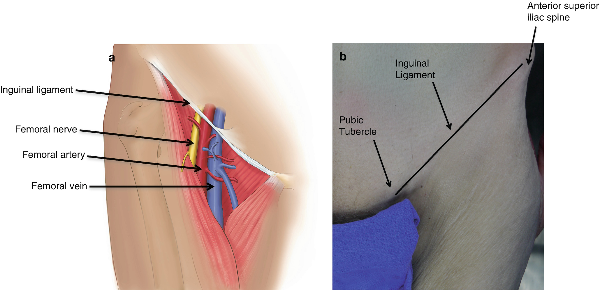 Anatomic landmarks for femoral arterial line or central line placement are....