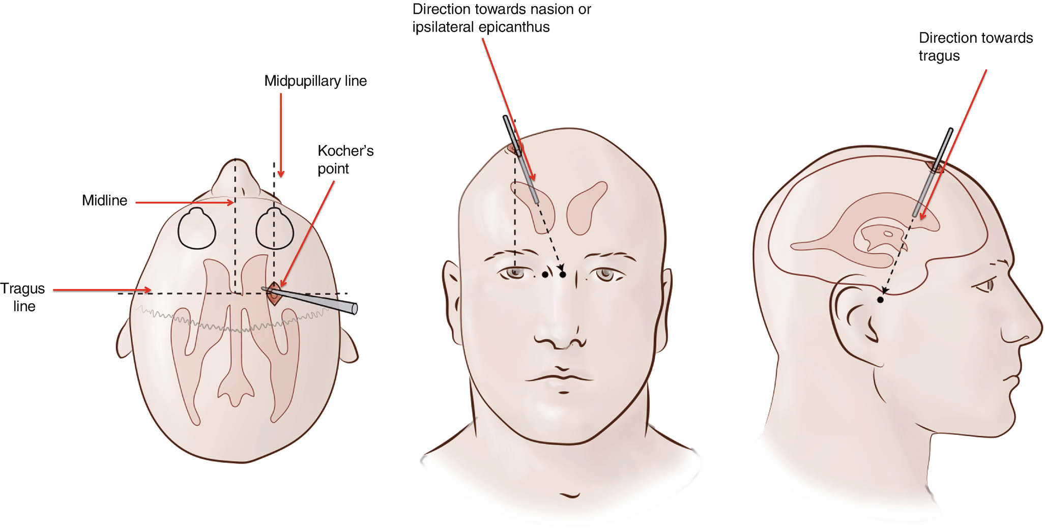 Intracranial Pressure Monitoring And Ventricular Drainage