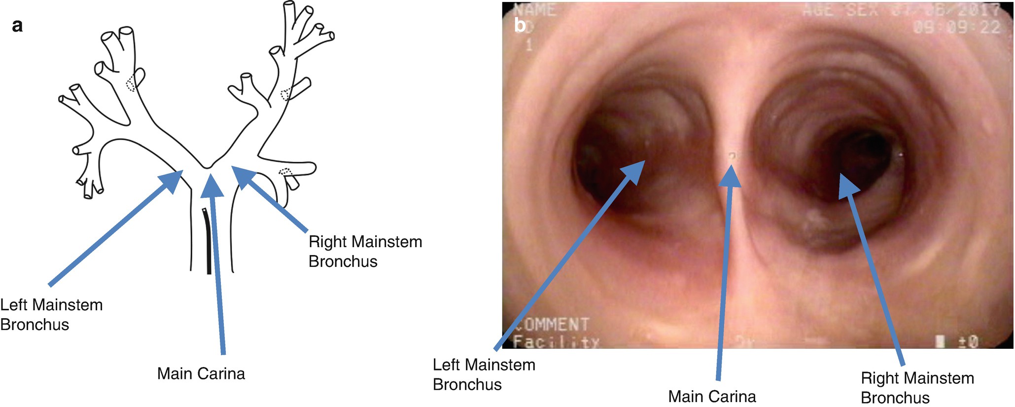 Bronchoscopy in the Intensive Care Unit SpringerLink