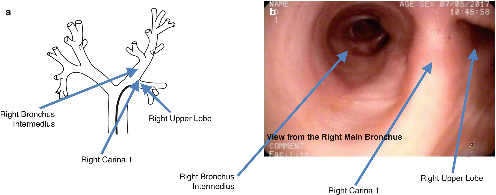 Bronchoscopy in the Intensive Care Unit SpringerLink