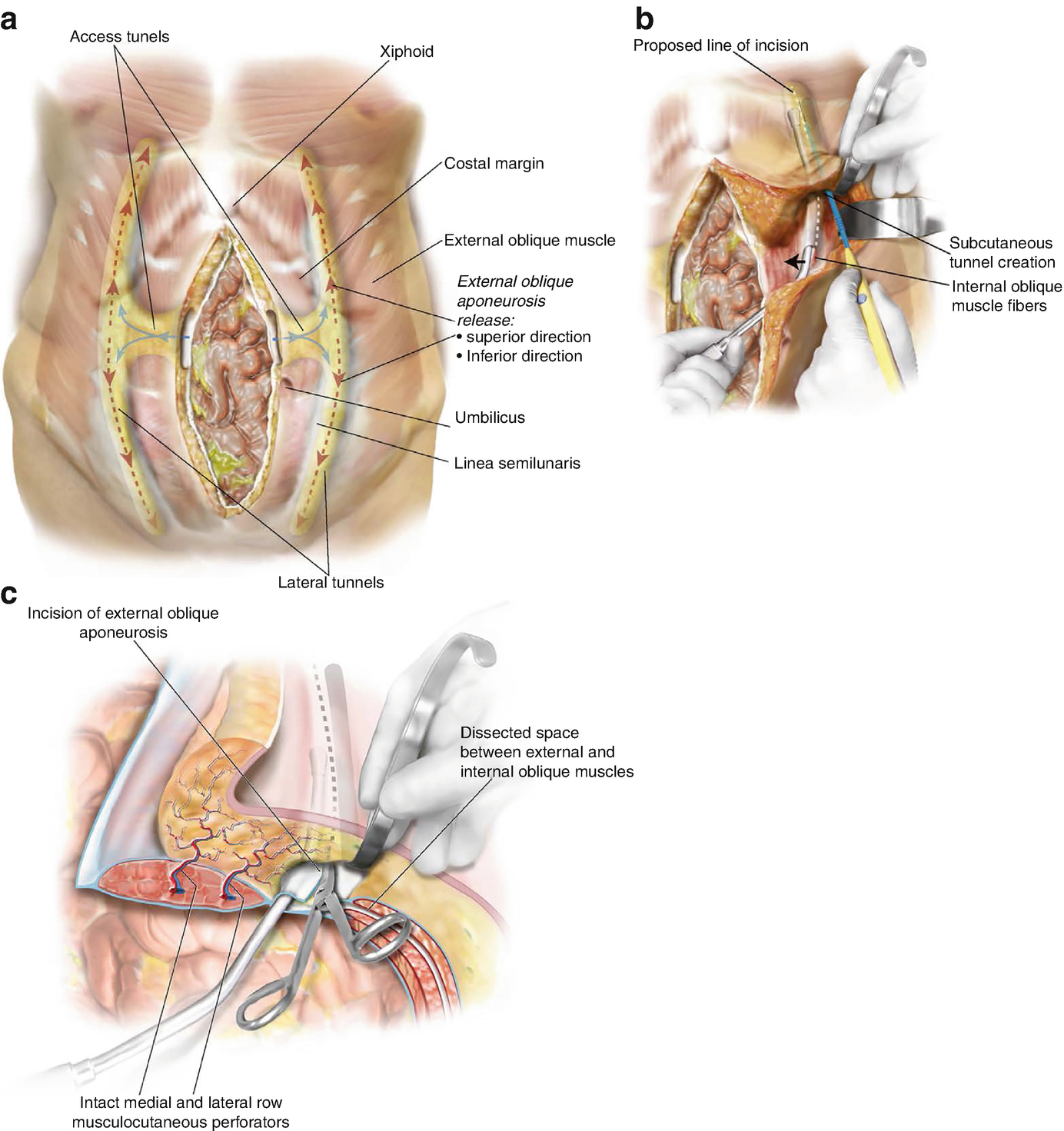 Ventral Abdominal Hernia Repair Technique External Oblique Release Springerlink