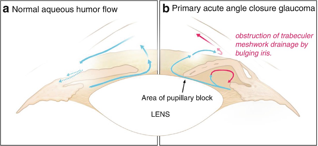 Acute Angle Closure Glaucoma Springerlink