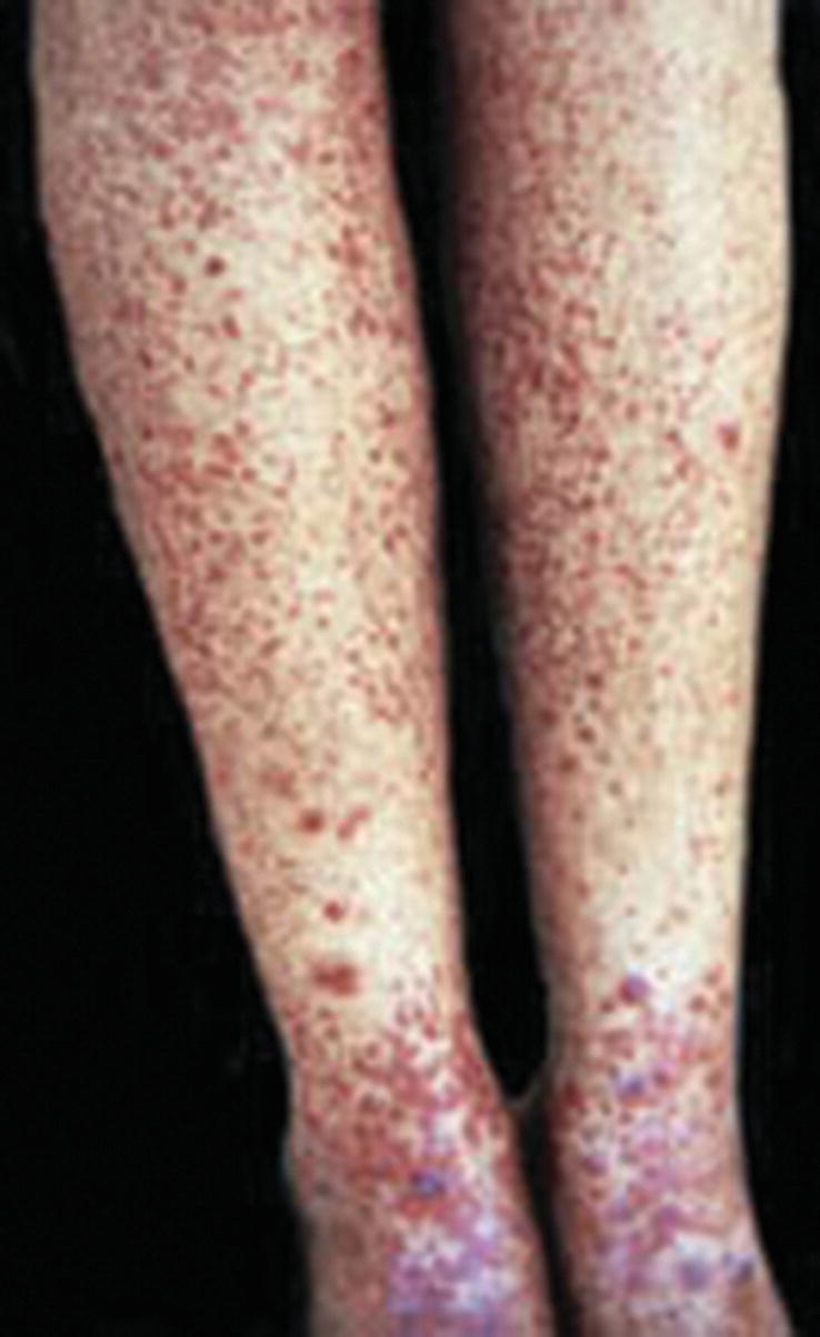 Purpura Springerlink Purpura Springerlink