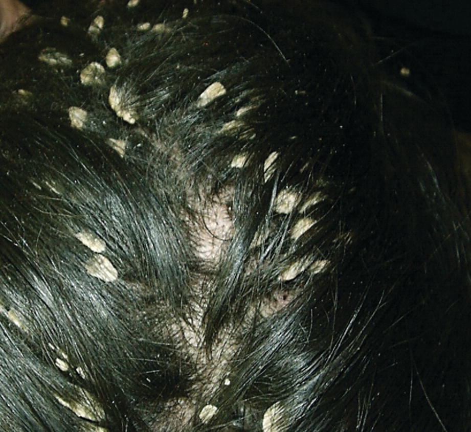 Hair Disorders Springerlink