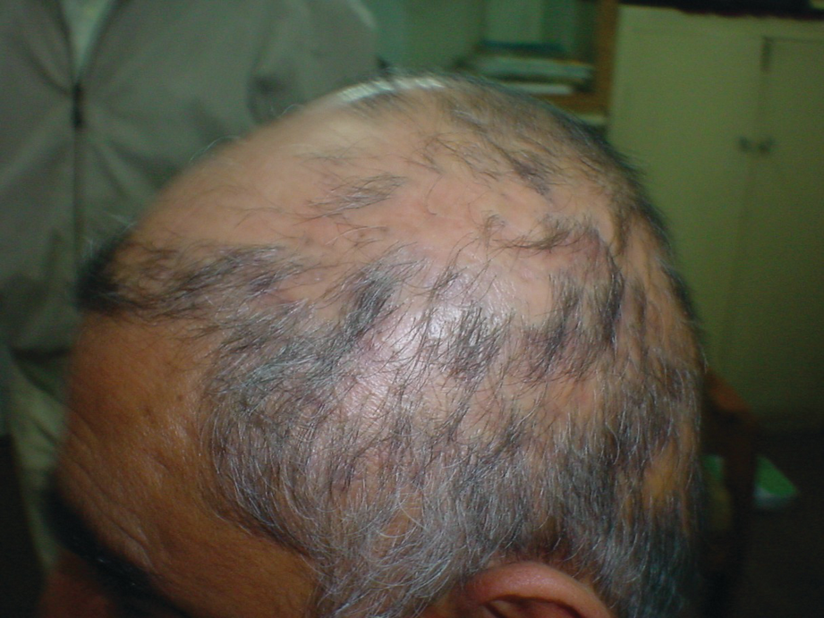 Hair Disorders Springerlink