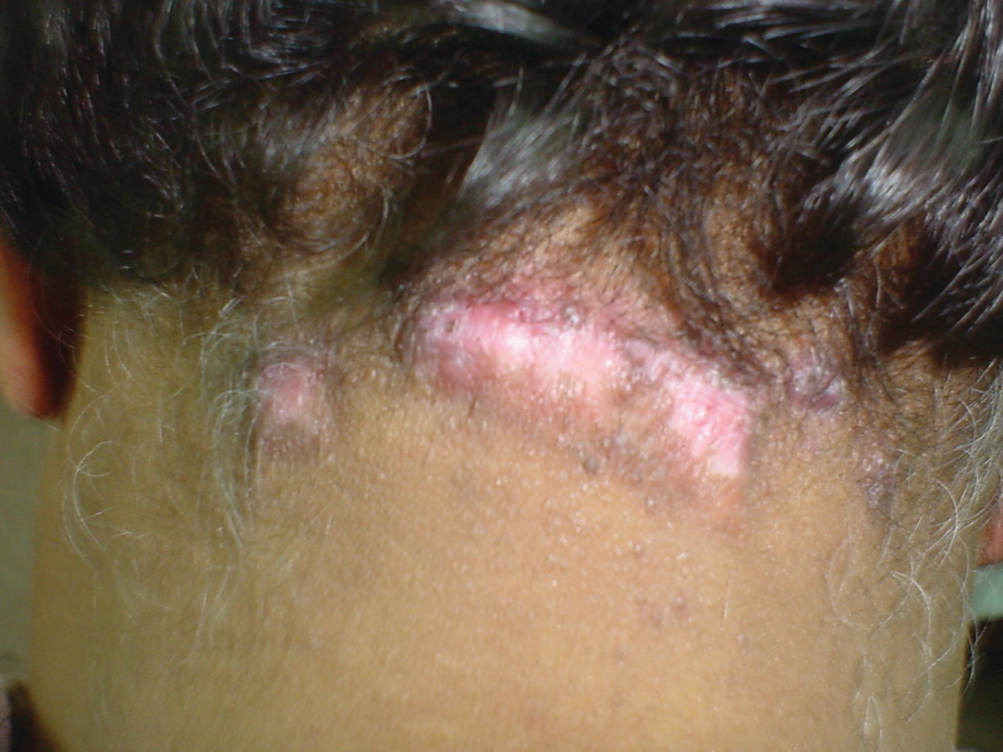 Hair Disorders Springerlink