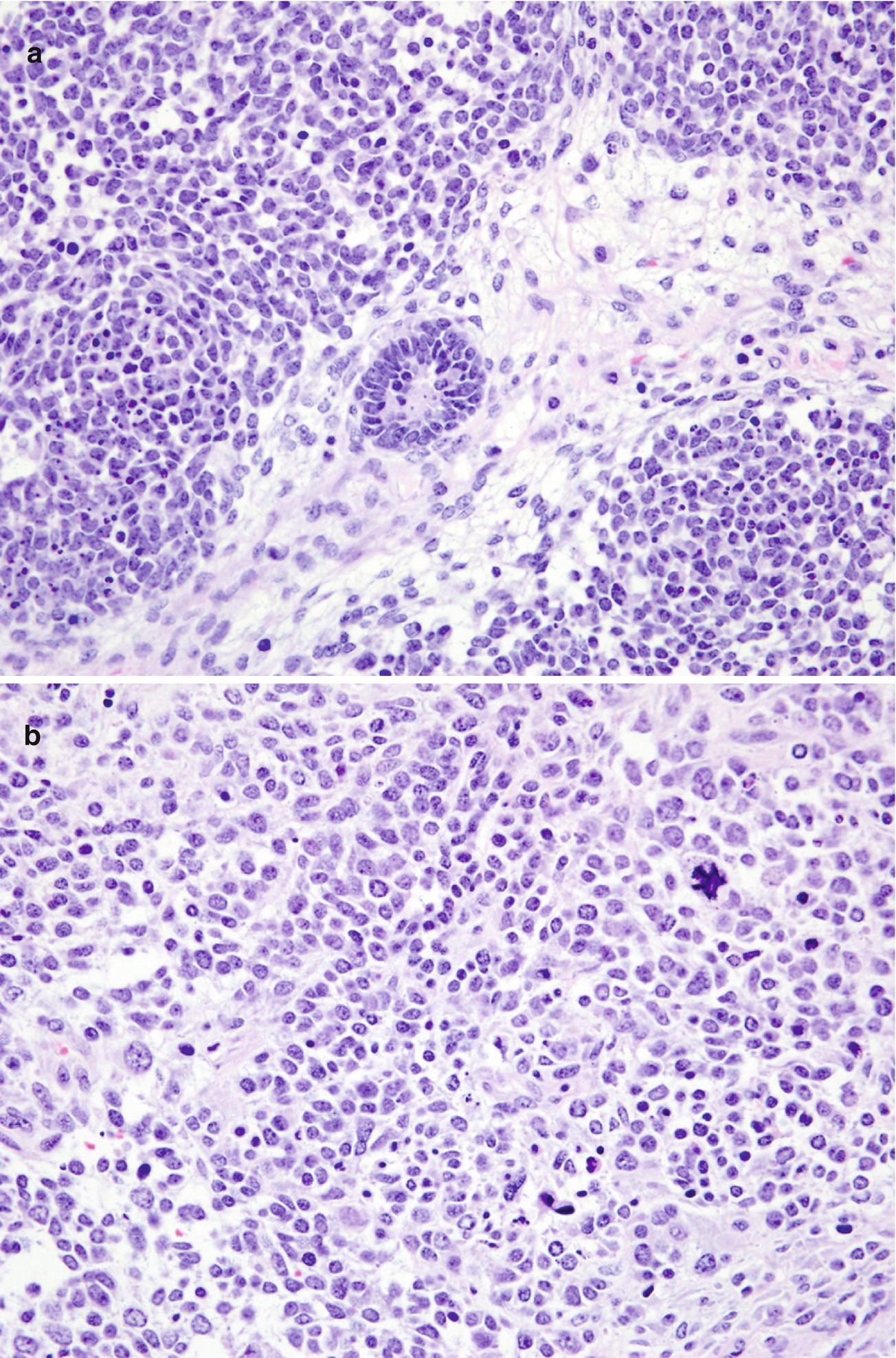 Molecular Pathology Of Pediatric Renal Tumors Springerlink